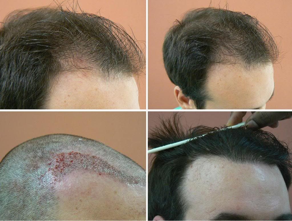 Cows lick hair transplant Three some big dick blowjobs